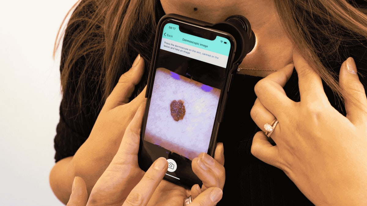 Hands hold a smartphone with a magnifying lens attachment against a mole at the base of a person's neck, with the app screen showing a close-up image of the mole